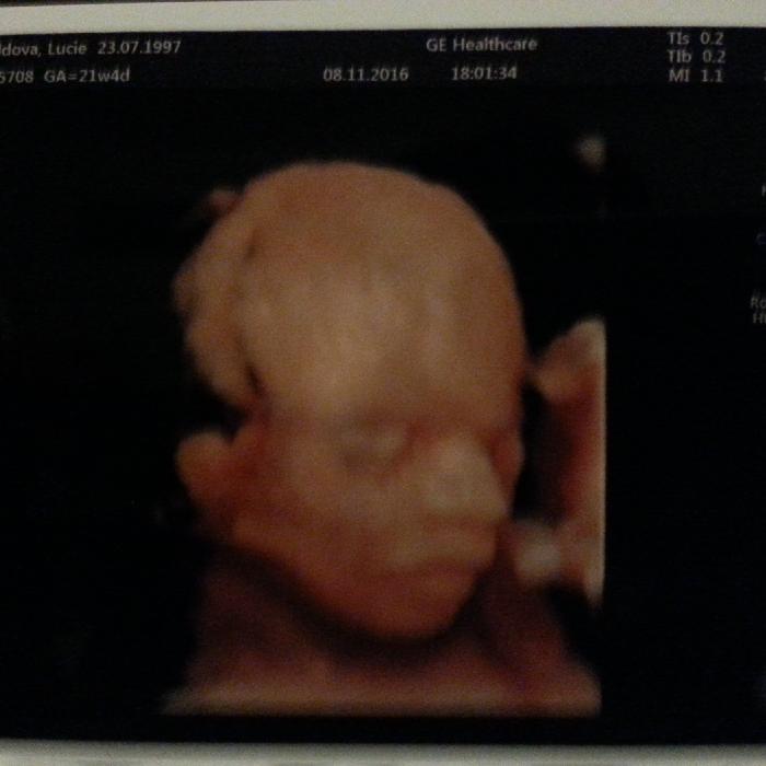 Obrázek ultrazvuku miminka č.1499 - Babyload.net